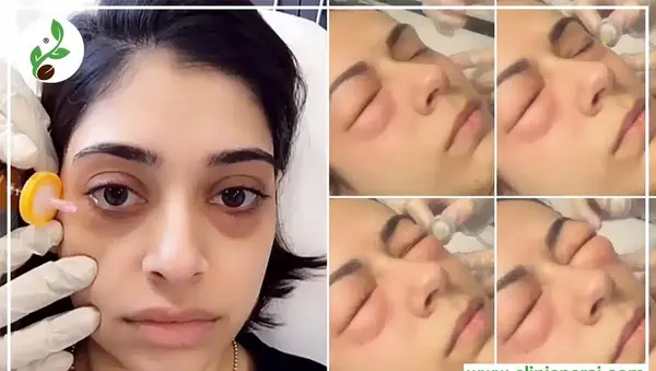 عکس قبل و بعد کربوکسی تراپی