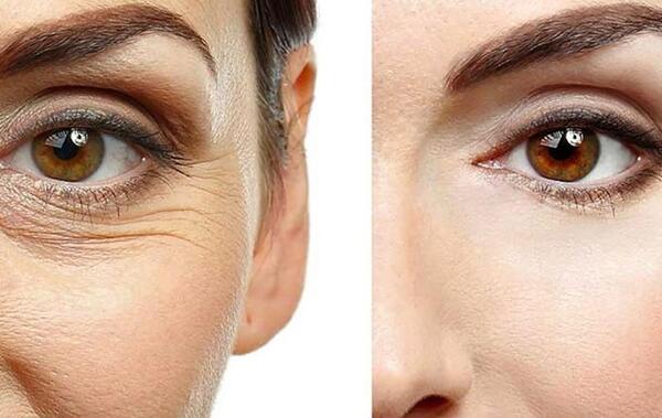 عکس قبل و بعد کربوکسی تراپی