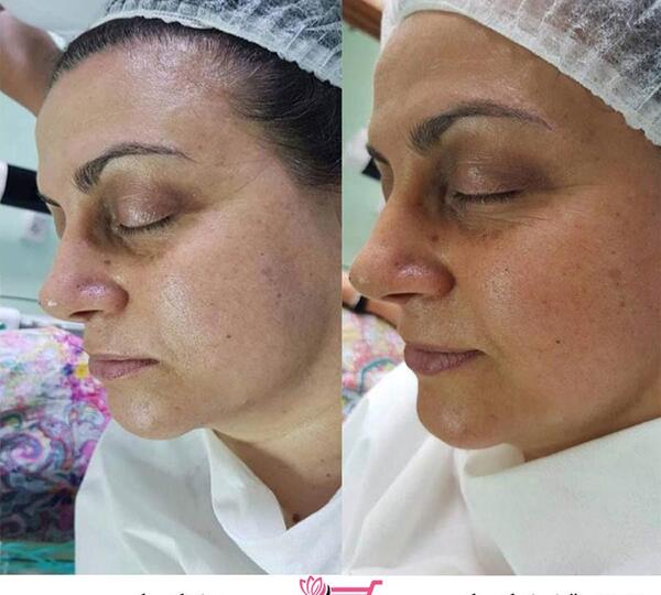 عکس قبل و بعد کربوکسی تراپی