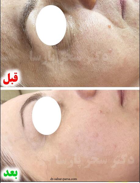 عکس قبل و بعد کربوکسی تراپی