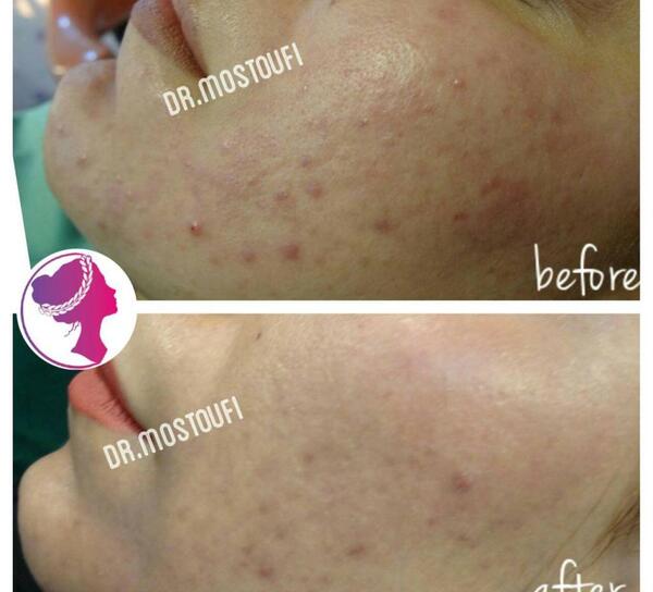 عکس قبل و بعد کربوکسی تراپی
