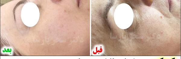 عکس قبل و بعد کربوکسی تراپی