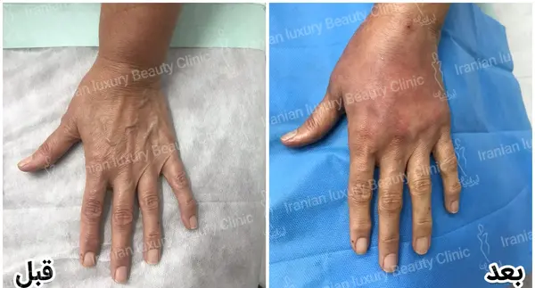 عکس قبل و بعد کربوکسی تراپی
