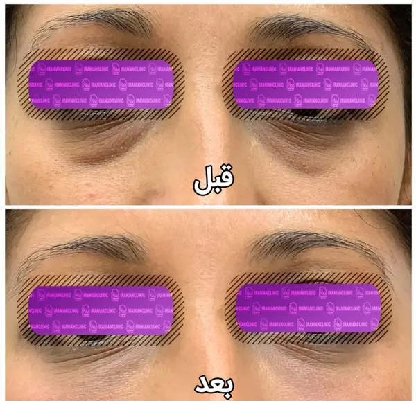 عکس قبل و بعد کربوکسی تراپی