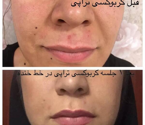 عکس قبل و بعد کربوکسی تراپی