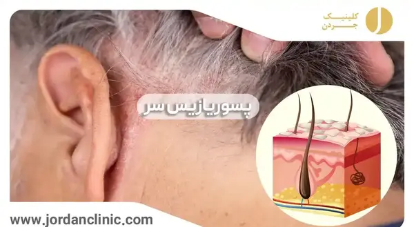 عکس پسوریازیس خفیف