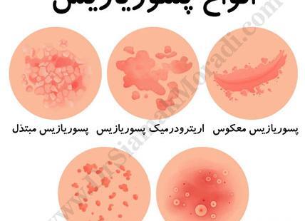 عکس پسوریازیس خفیف