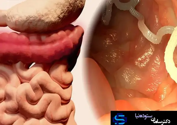 عکس عفونت در مدفوع