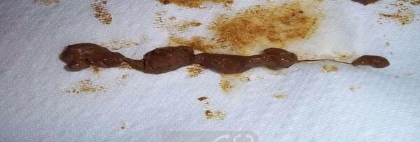 عکس عفونت در مدفوع