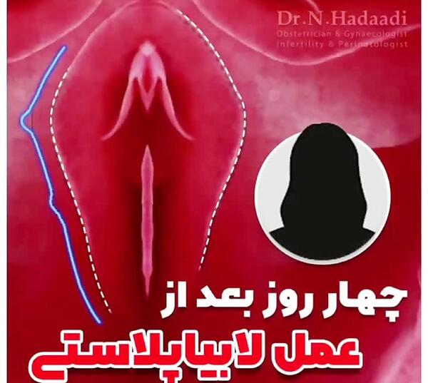 عکس قبل و بعد از عمل لابیاپلاستی