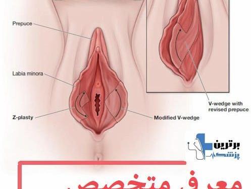 عکس قبل و بعد از عمل لابیاپلاستی