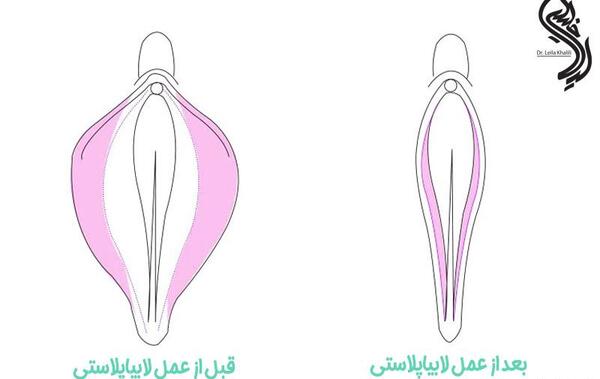 عکس قبل و بعد از عمل لابیاپلاستی