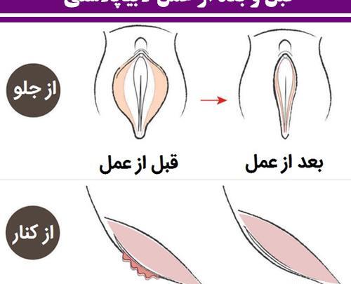 عکس قبل و بعد از عمل لابیاپلاستی