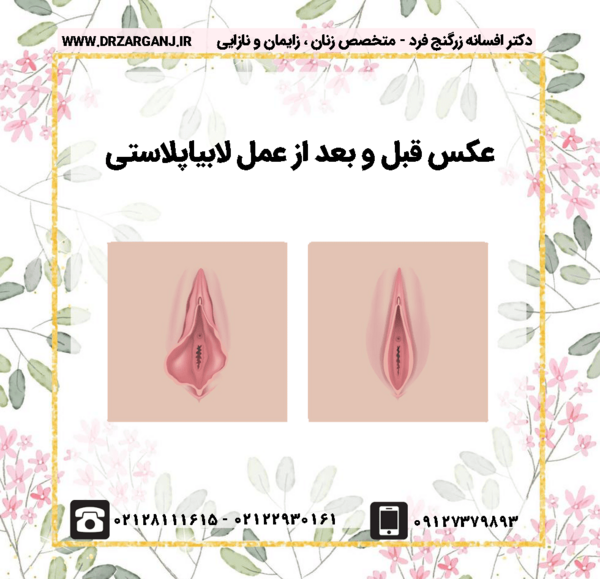 عکس قبل و بعد از عمل لابیاپلاستی