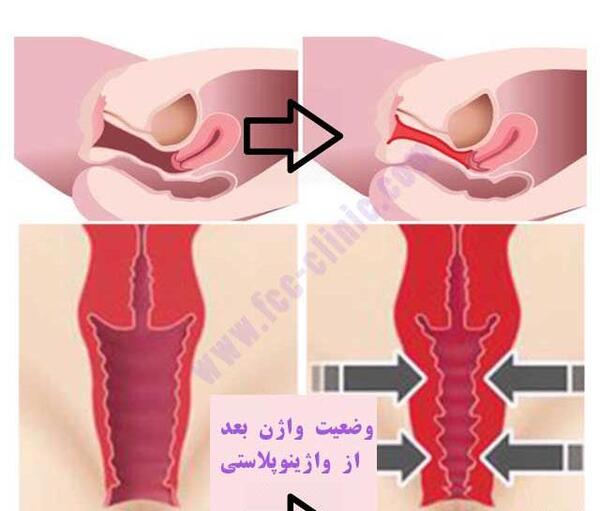 عکس قبل و بعد از عمل لابیاپلاستی