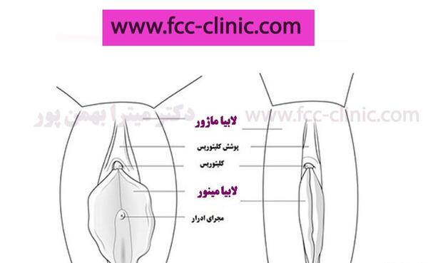 عکس قبل و بعد از عمل لابیاپلاستی