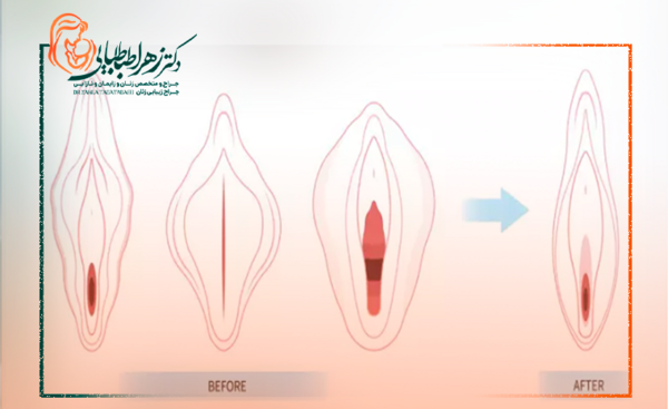 عکس قبل و بعد از عمل لابیاپلاستی
