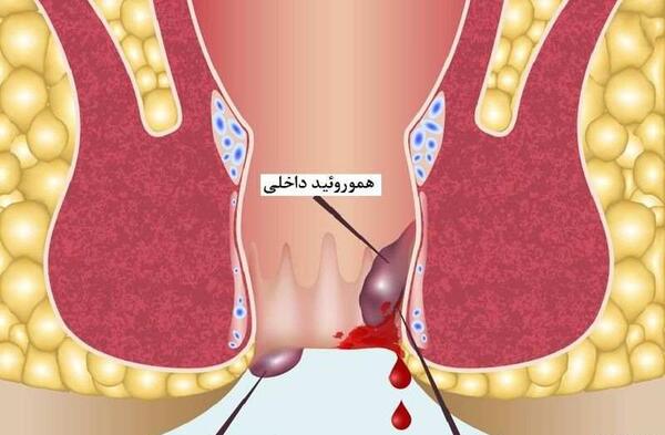 عکس خون در مدفوع