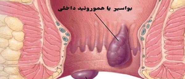 عکس خون در مدفوع