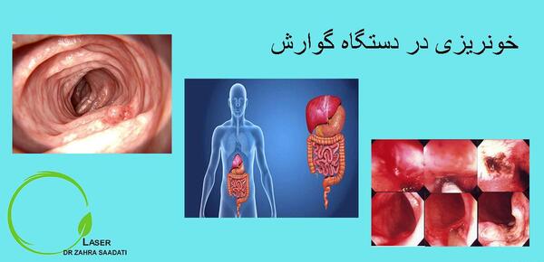 عکس خون در مدفوع
