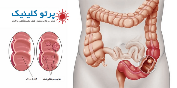 عکس خون در مدفوع