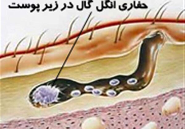 عکس بیماری پوستی گال