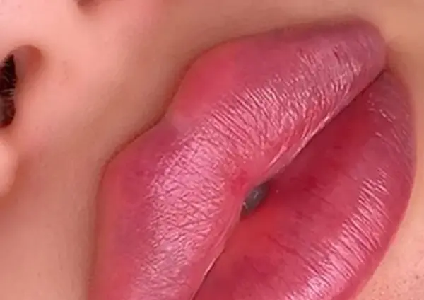 عکس لب ژل
