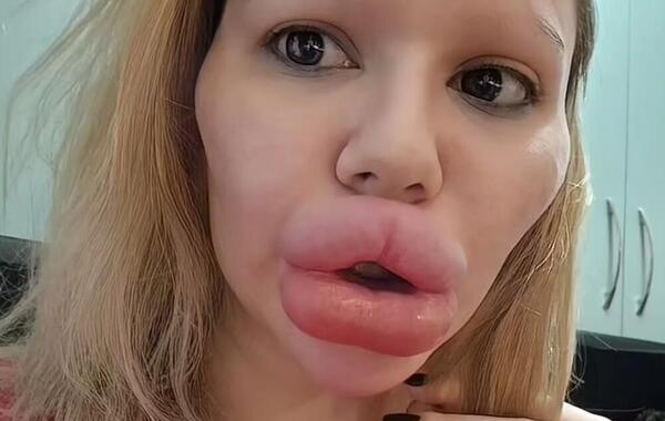 عکس لب ژل