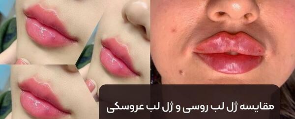 عکس لب ژل