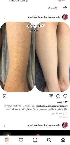 عکس سوتی های لیزر نی نی سایت
