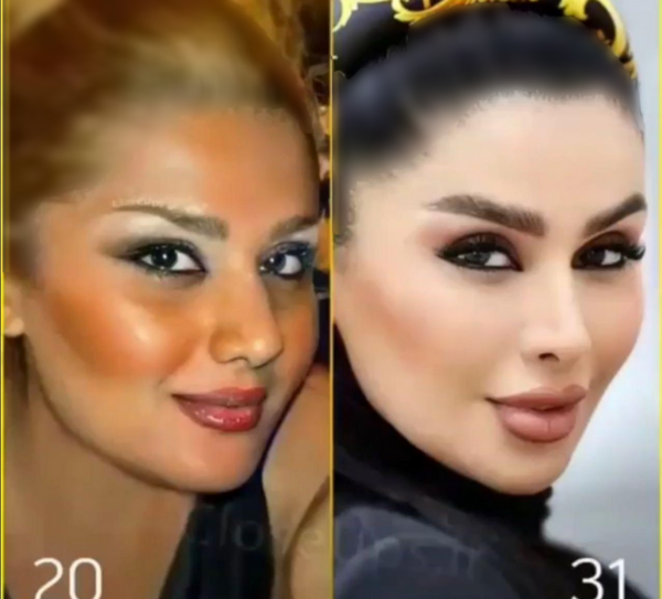 عکس دنیا جهانبخت قبل عمل زیبایی