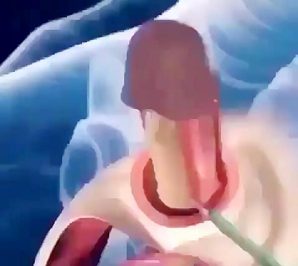 عکس عمل ترنس ها