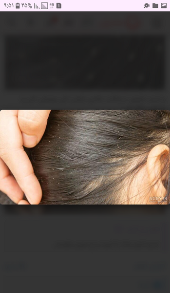 عکس شپش سر نی نی سایت