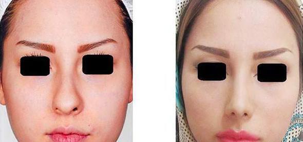 عکس آزاده صمدی قبل از عمل زیبایی
