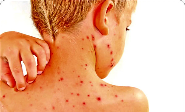 عکس آبله میمون روی پا