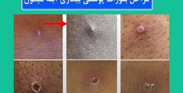 عکس آبله میمون روی پا