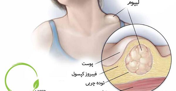عکس غده روی سر