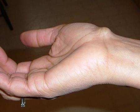 عکس غده روی سر