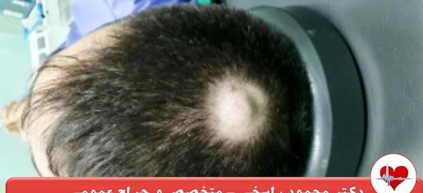 عکس غده روی سر