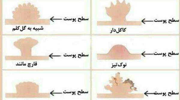 عکسی از زگیل تناسلی