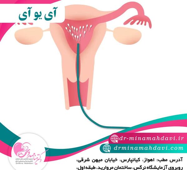 عکس آی یو آی