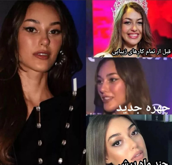 عکس دیلان چیچک دنیز قبل از عمل