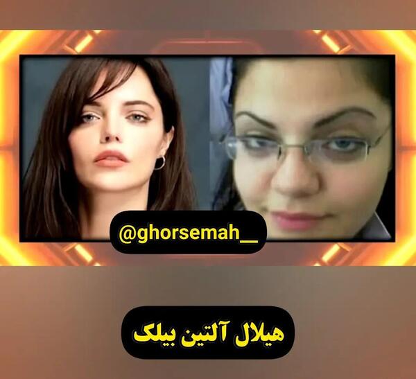 عکس دیلان چیچک دنیز قبل از عمل