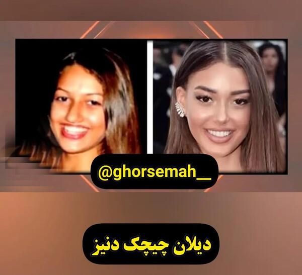 عکس دیلان چیچک دنیز قبل از عمل