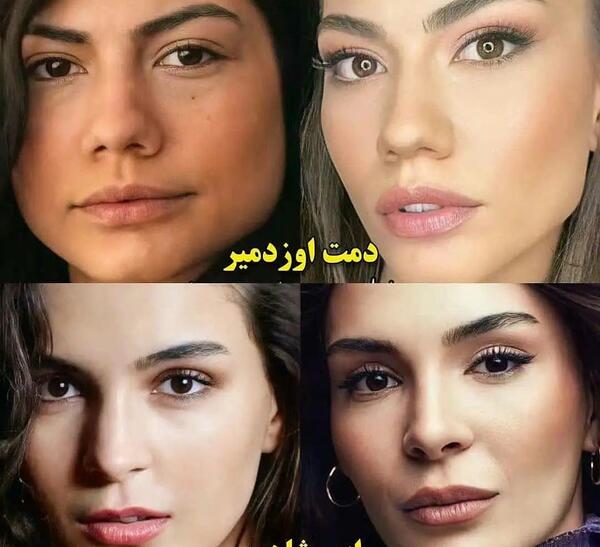 عکس دیلان چیچک دنیز قبل از عمل