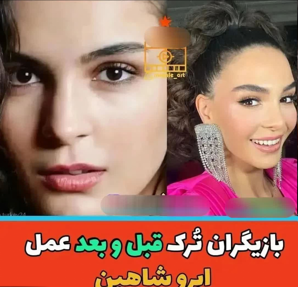 عکس دیلان چیچک دنیز قبل از عمل
