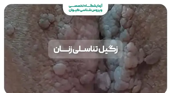 عکسی از زگیل تناسلی زنان