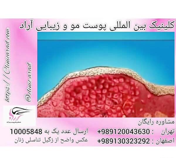 عکسی از زگیل تناسلی زنان