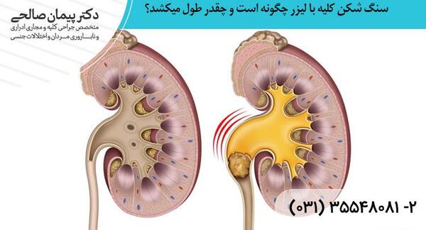 عکس دستگاه لیزر کلیه