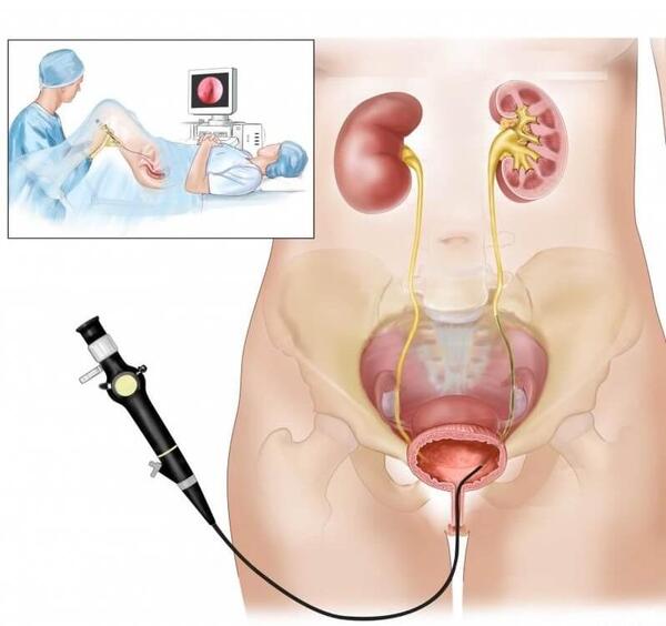 عکس دستگاه لیزر کلیه